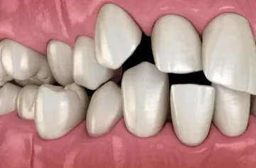 Аномалии количества и положения зубов