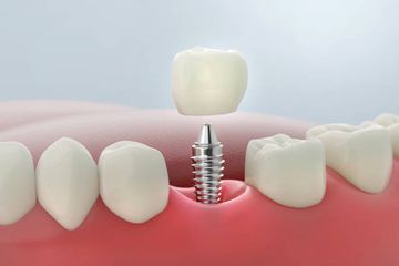 Corrección de la Dehiscencia Ósea Bucal Peri-Implantar Tras la Técnica de Capa Aumentada Subperióstica con Injerto Xenógeno en Bloque o Particulado: Un Estudio Retrospectivo