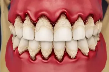 Symptomatic periodontitis as a manifestation of systemic diseases