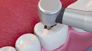 Comparative Analysis of Materials for Retrograde Filling Conducted on Extracted Teeth in Wet and Dry Environments. Comparative Analysis of Materials for Retrograde Filling Conducted on Extracted Teeth in Wet and Dry Environments.