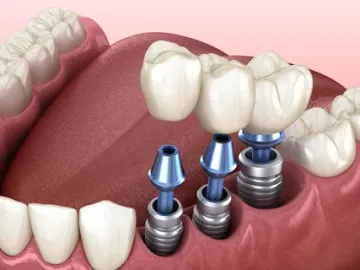Dental implant planning Dental implant planning