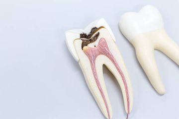 Adhesive post-endodontic restorations with fiber posts: push-out tests and SEM observations