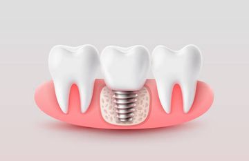 Errors in Implant Positioning due to Lack of Planning: A Clinical Case Report of New Prosthetic Materials and Solutions Errors in Implant Positioning due to Lack of Planning: A Clinical Case Report of New Prosthetic Materials and Solutions