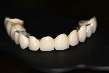 Erros na confecção de próteses metalocerâmicas. Causas e prevenção