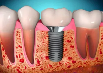 Morphological basis of dental implantation Morphological basis of dental implantation