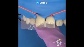 А clinical case of Dr. Bora Korkut: direct composite restorations of crown fractures