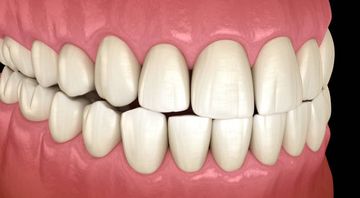 Microcomputed tomography analysis of the root canal morphology of single-rooted mandibular canines