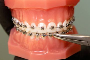 Bimaxillary advancement with aesthetic and functional improvement Bimaxillary advancement with aesthetic and functional improvement
