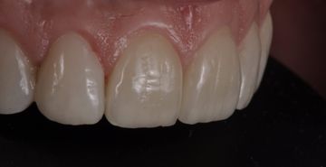 Nuovi materiali per il trattamento dell'usura dei denti