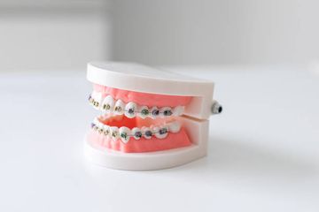 Retention in Orthodontics. Retention Appliances: Fixed and Removable Retainers