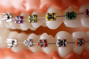 Orthodontic repositioning of lateral incisors into central incisors