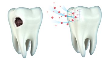 Лечение кариеса эмали