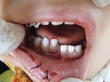 Fractures of the lower jaw in children