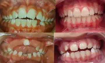 Study of skeletal changes in individuals with anterior open bite treated with JFO