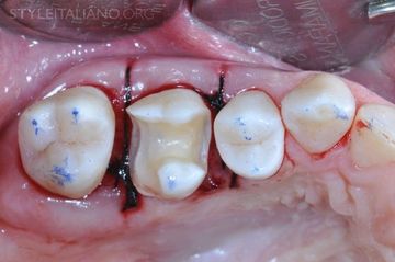 Surgical crown lengthening for distal restorations