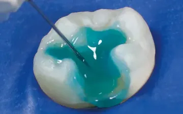 Основи адгезивної стоматології