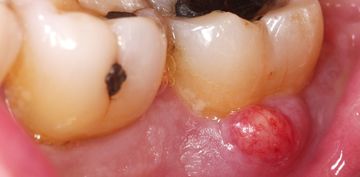 Complicaciones durante y después de la profilaxis dental