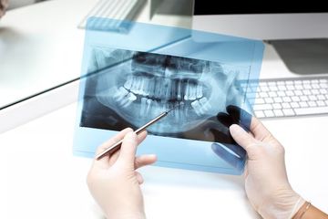 Micro-CT assessment of gap-containing areas along the gutta-percha-sealer interface in oval-shaped canals