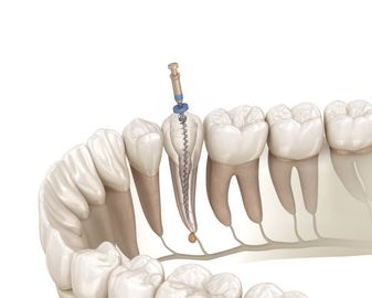 Analisi dello stress, tramite studio degli elementi finiti, in denti ricostruiti con perno moncone e corona