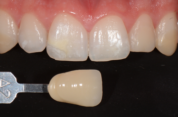 Sbiancamento e rimozione delle macchie dei denti