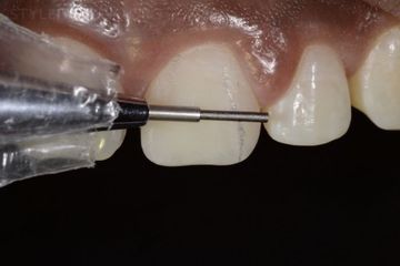 A força do lápis nas restaurações de dentes anteriores com compósito
