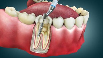 Influence of access cavity preparation on the dentine thickness of mesial canals of mandibular molars prepared with reciprocating instruments