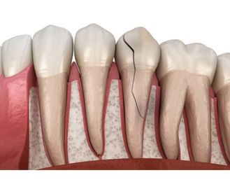 Manejo clínico e cicatrização subsequente de dentes com fraturas horizontais na raiz