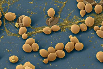 Candida-Stomatitis. Ätiologie, Symptome, Diagnose