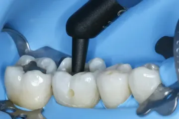 Последовательность реставрации жевательных зубов