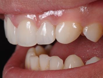 Direct restoration of a tooth with an irregular shape