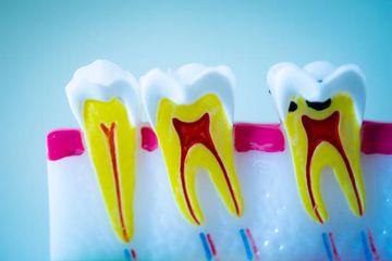 Zur Kausalität zwischen dentinalen Defekten und der Wurzelkanalaufbereitung: Eine Mikro-CT-Bewertung