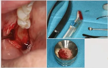 Regeneración ósea horizontal en la región frontomaxilar con membrana reabsorbible: enfoque periodontal, prostodóncico y quirúrgico