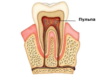 Этиология и патогенез пульпита