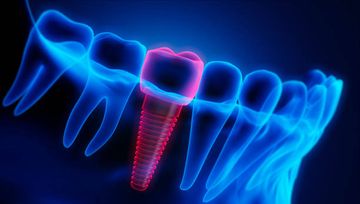 Directrices protésicas para prevenir fracturas de implantes y periimplantitis: una declaración de consenso de la comunidad de implantes Osstem