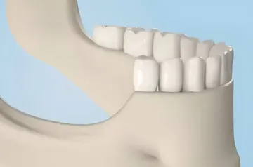 Implantationsprobleme: Atrophie des Knochengewebes, Knochenqualität Implantationsprobleme: Atrophie des Knochengewebes, Knochenqualität