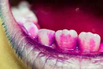 Классификация зубных отложений