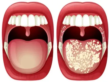 Проявления микозов в полости рта. Кандидозный стоматит