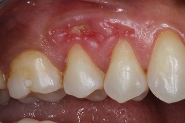 Pigmentation of the gums. Treatment, errors and complications