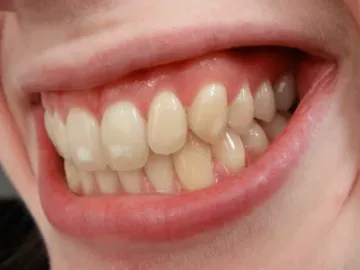 Endemic enamel mottling. Fluorosis