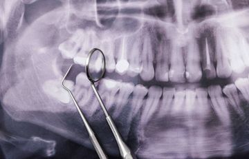 Micro-CT assessment of dentinal micro-cracks after root canal filling procedures