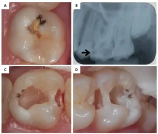 Minimum intervention oral care: defining the future of caries management