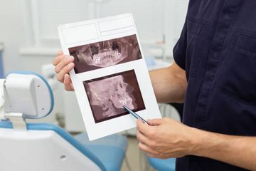 Micro–computed Tomography Study of Oval-shaped Canals Prepared with the Self-adjusting File, Reciproc, WaveOne, and ProTaper Universal Systems