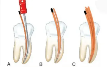 Evolução do uso da gutapercha como preenchedor