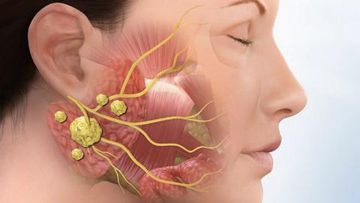 Salivary stone disease. Clinic, diagnosis, treatment