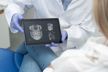 Индивидуальная 3D-печатная титановая сетка для регенерации сложного костного дефекта в эстетической зоне: клинический случай с использованием полностью цифрового рабочего процесса Индивидуальная 3D-печатная титановая сетка для регенерации сложного костного дефекта в эстетической зоне: клинический случай с использованием полностью цифрового рабочего процесса