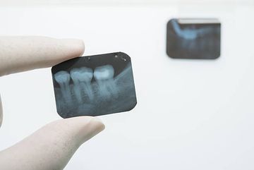 Micro-computed tomographic analysis of the mesial root of mandibular first molars with bifid apex