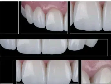 Direct Composite Veneers: A Clinical Guide to Selecting the Correct Layering Technique