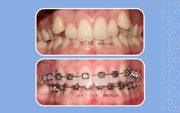 360 PASSIVE SELF-LIGATING BRACKETS – CLINICAL CASE