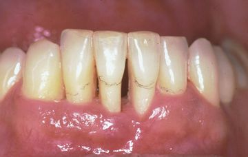 Miller classification of gum recession