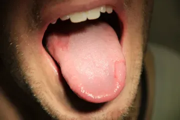 Проявления дерматозов на слизистой полости рта